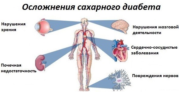 Гангрена нижних конечностей при сахарном диабете фото